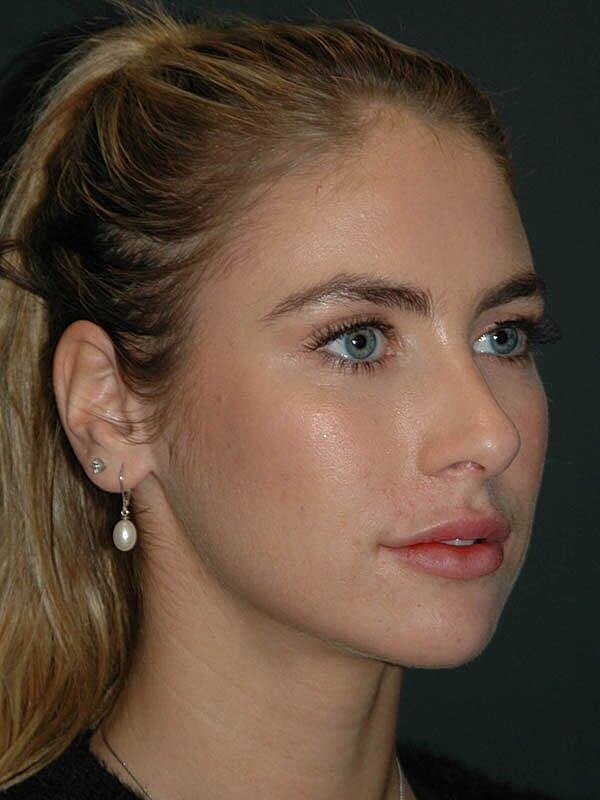 Lip Augmentation Before & After