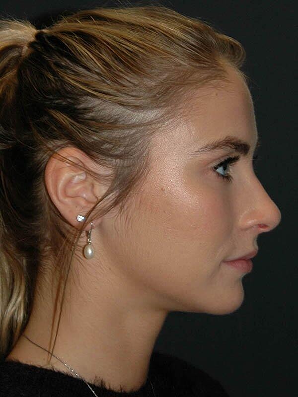 Lip Augmentation Before & After