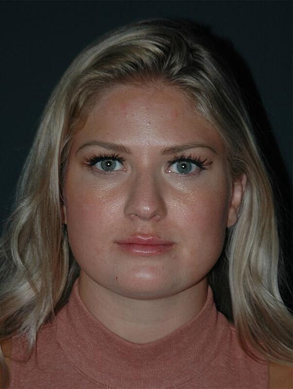 Lip Augmentation Before & After