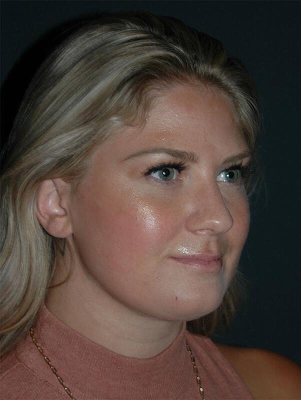 Lip Augmentation Before & After