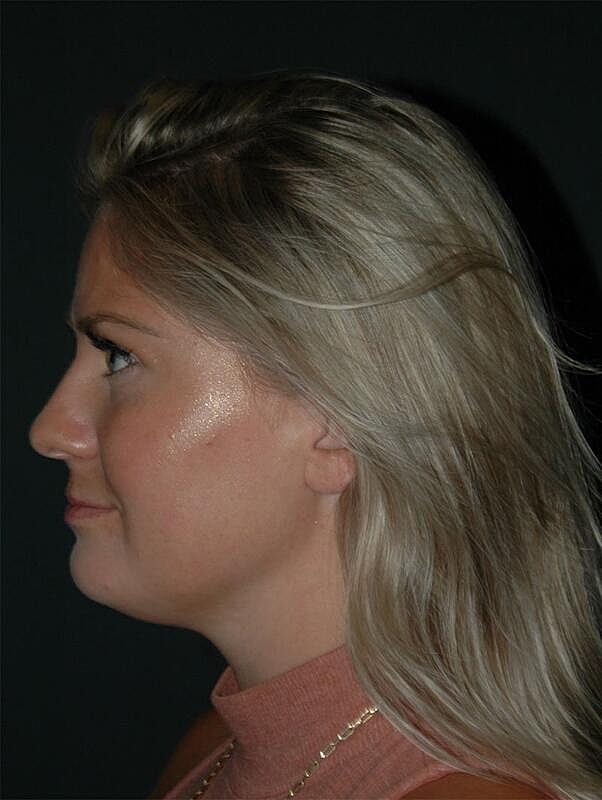 Lip Augmentation Before & After