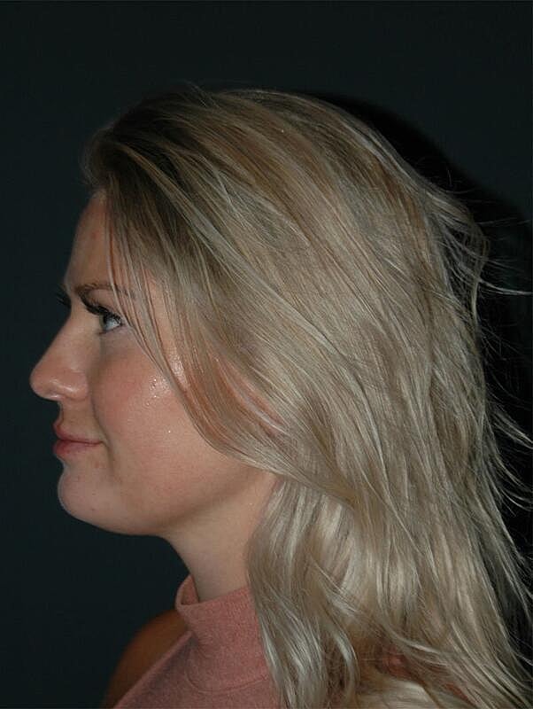 Lip Augmentation Before & After