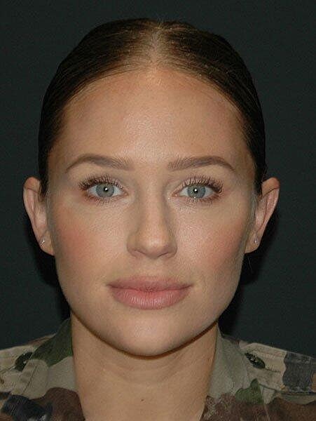 Lip Augmentation Before & After