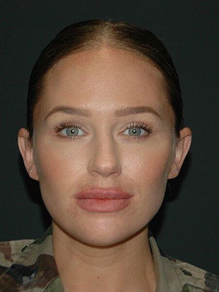 Lip Augmentation Before & After