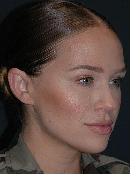 Lip Augmentation Before & After