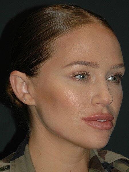 Lip Augmentation Before & After