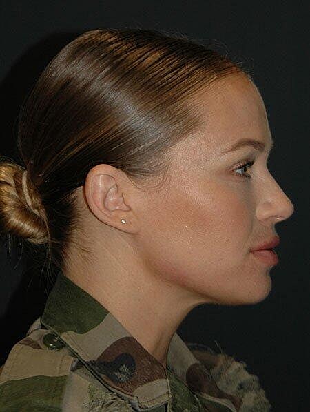 Lip Augmentation Before & After