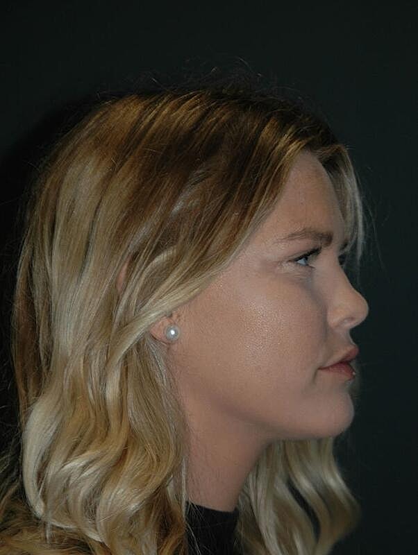 Lip Augmentation Before & After