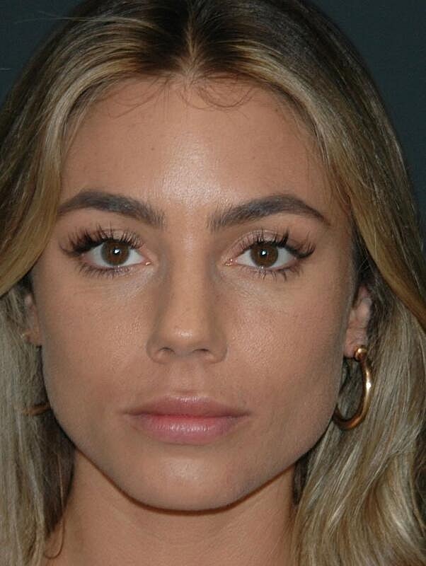 Lip Augmentation Before & After