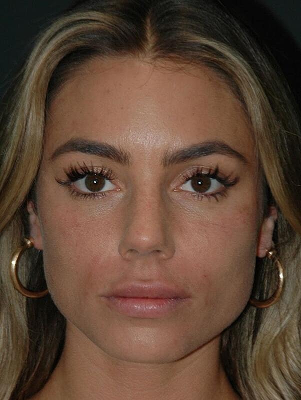 Lip Augmentation Before & After
