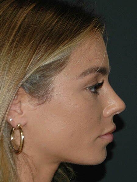 Lip Augmentation Before & After