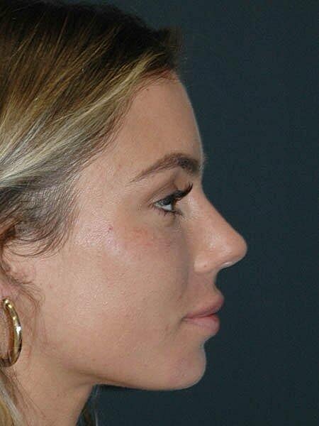 Lip Augmentation Before & After