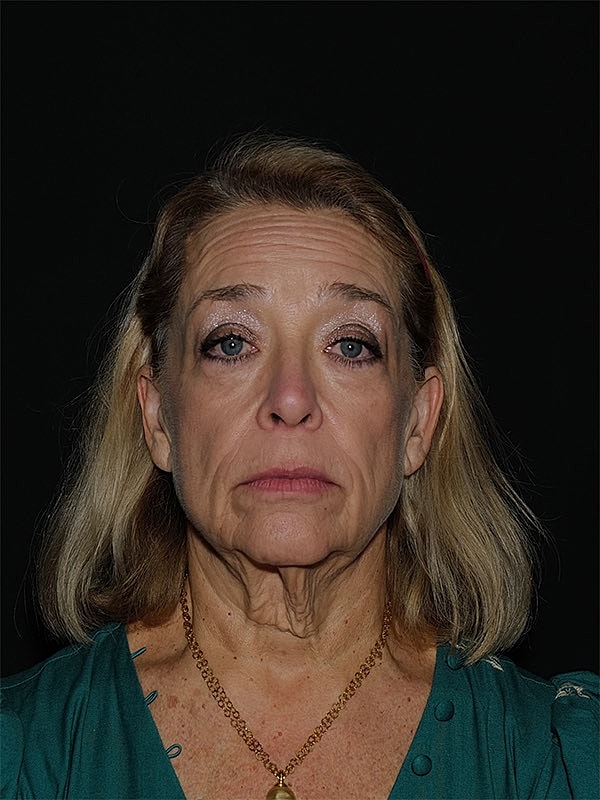 Blepharoplasty Before & After