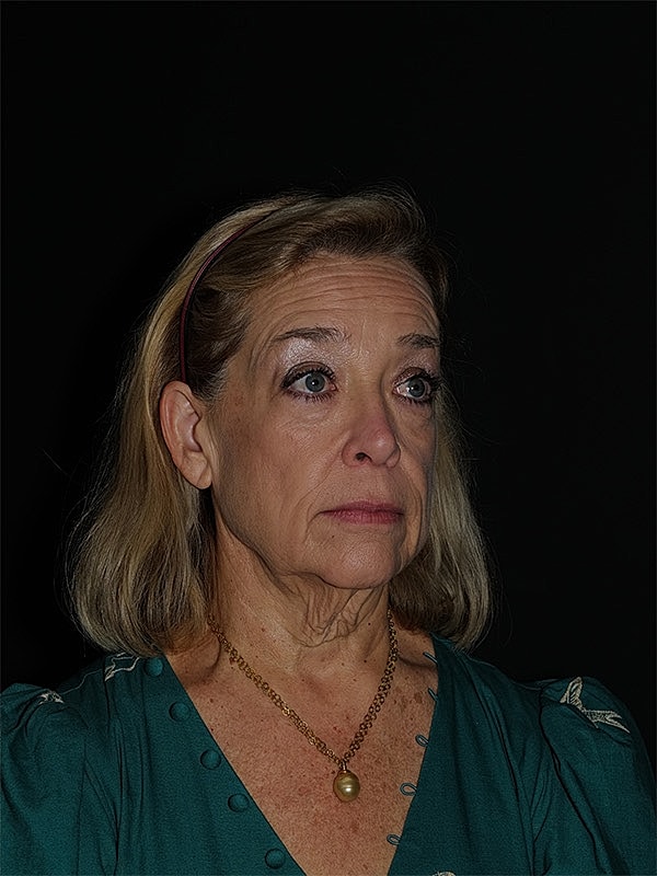Blepharoplasty Before & After