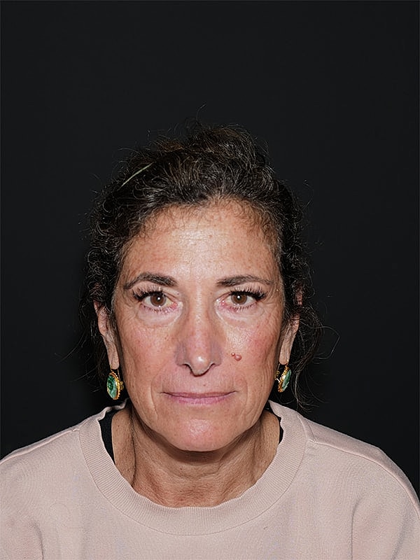 Blepharoplasty Before & After