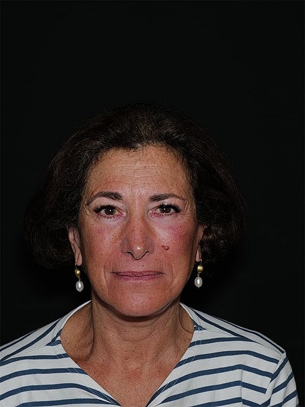 Blepharoplasty Before & After