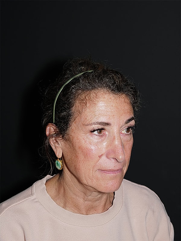 Blepharoplasty Before & After