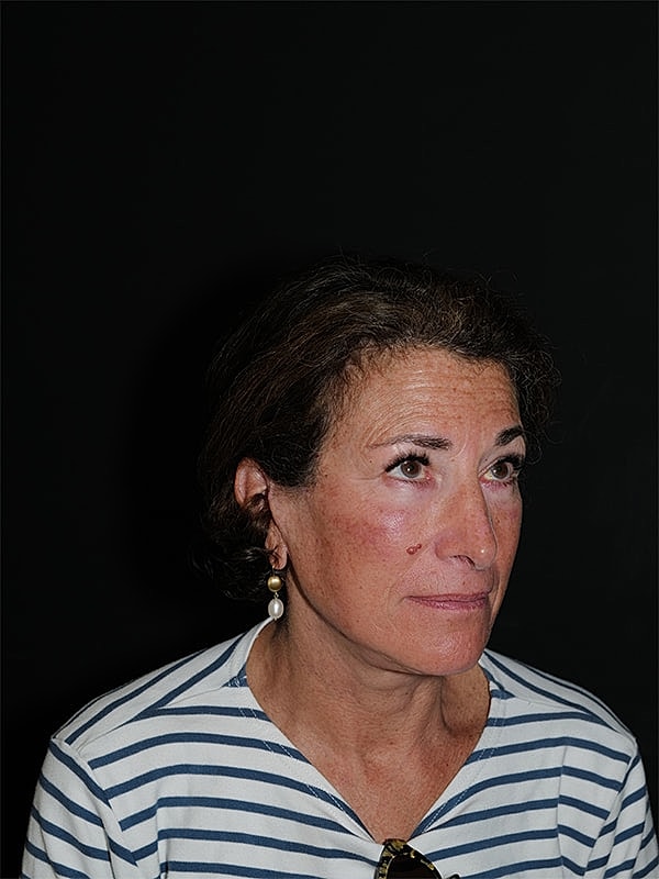 Blepharoplasty Before & After