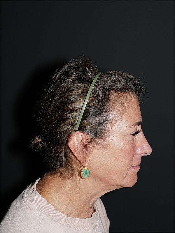Blepharoplasty Before & After