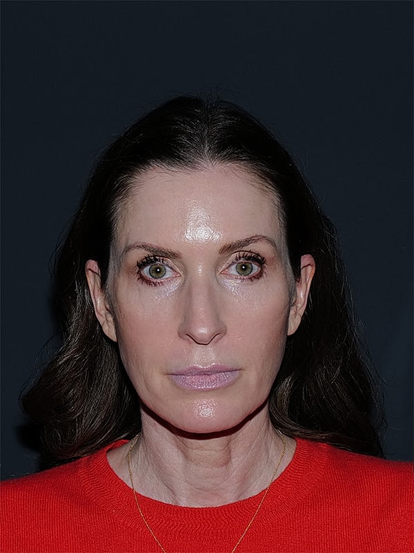 Blepharoplasty Before & After