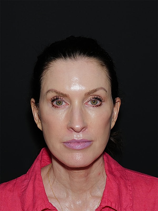 Blepharoplasty Before & After