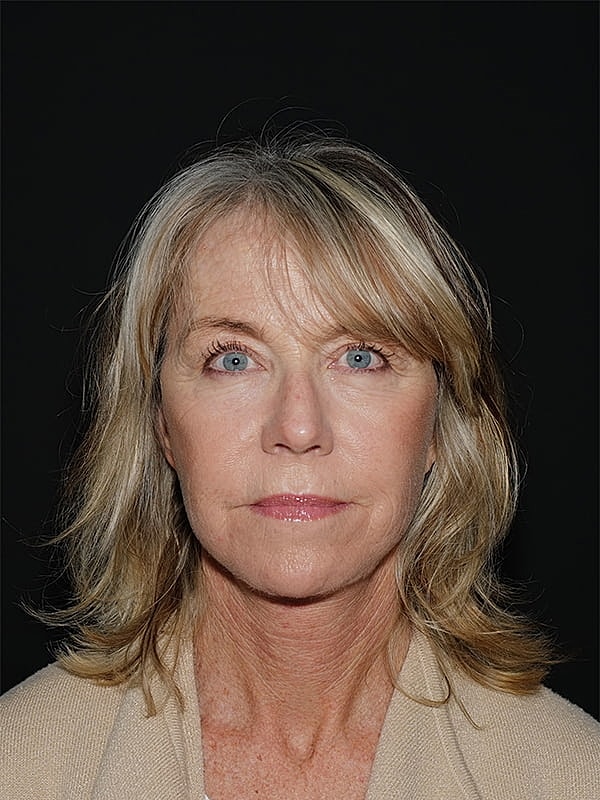 Blepharoplasty Before & After