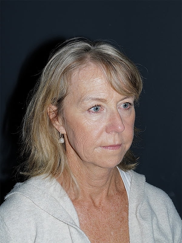 Blepharoplasty Before & After