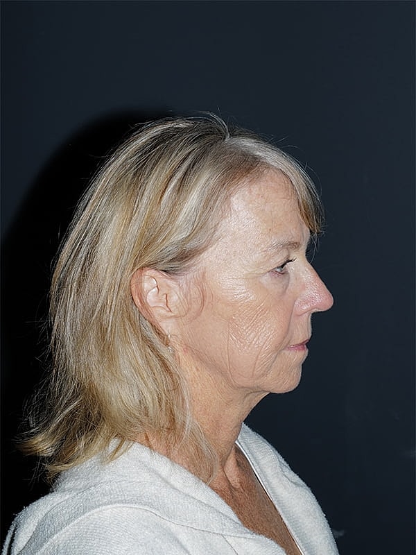 Blepharoplasty Before & After