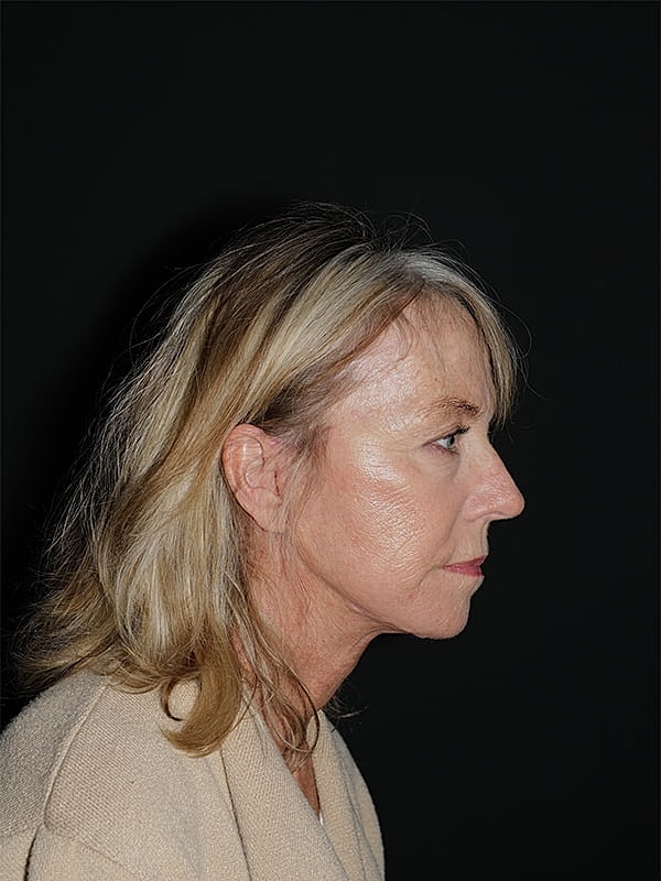 Blepharoplasty Before & After