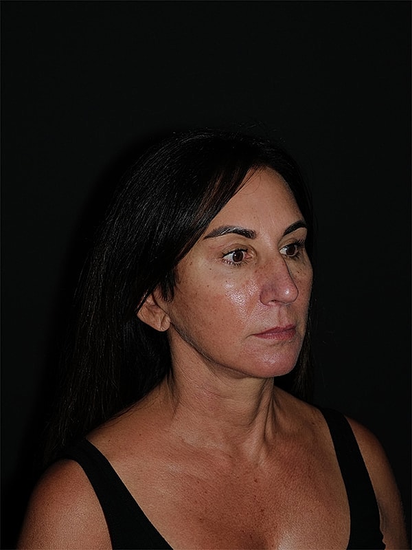 Blepharoplasty Before & After