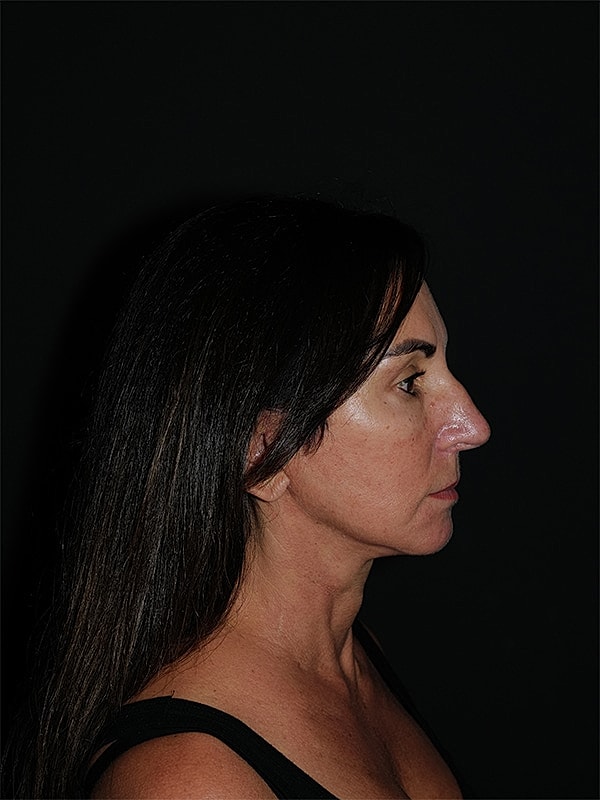 Blepharoplasty Before & After