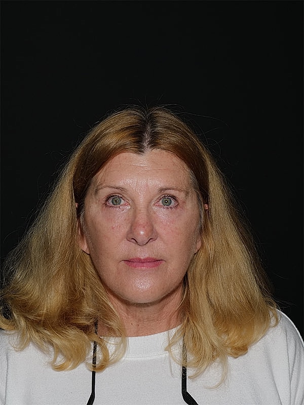 Blepharoplasty Before & After