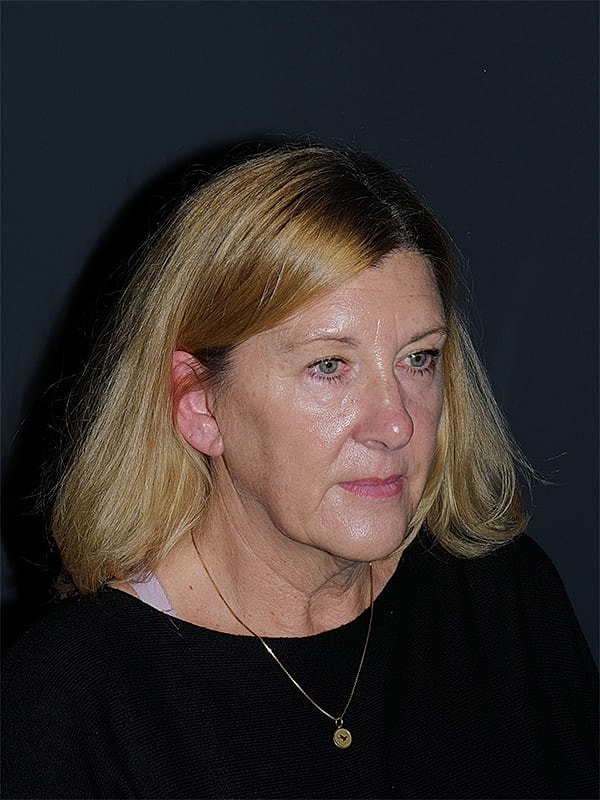 Blepharoplasty Before & After