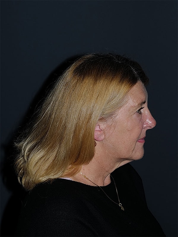 Blepharoplasty Before & After