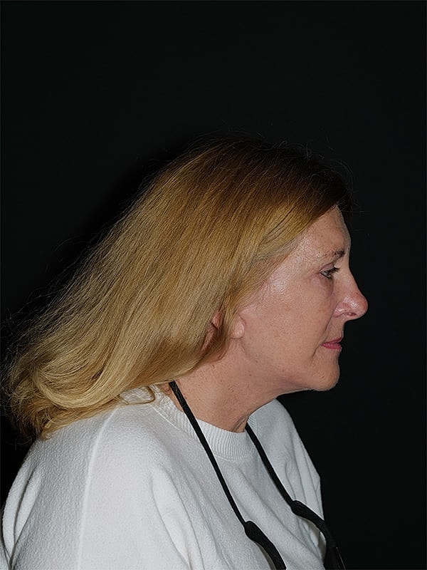 Blepharoplasty Before & After
