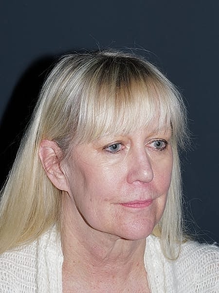 Blepharoplasty Before & After