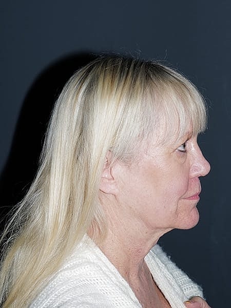 Blepharoplasty Before & After
