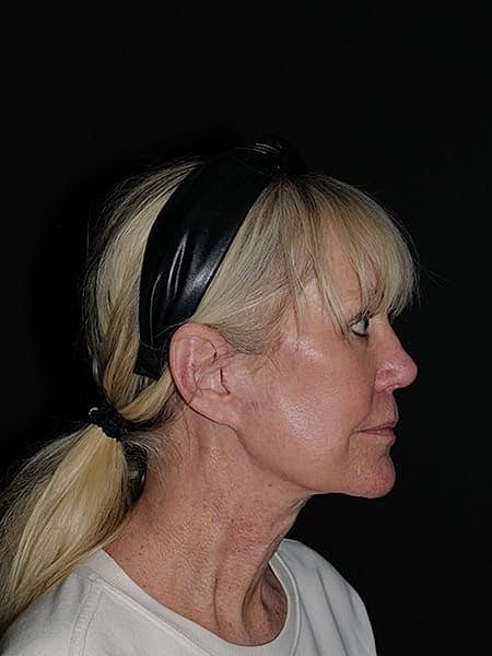 Blepharoplasty Before & After