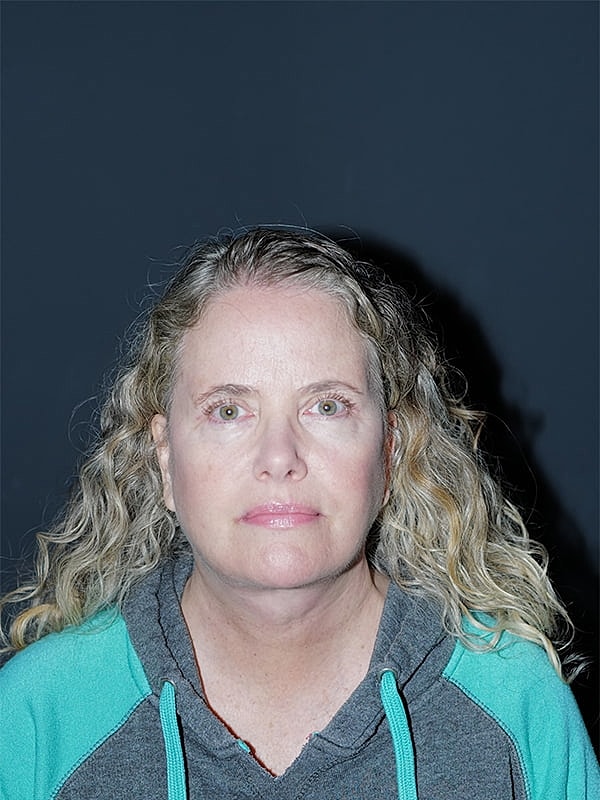 Blepharoplasty Before & After