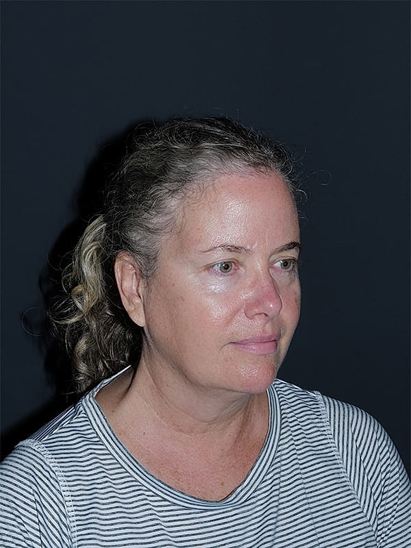 Blepharoplasty Before & After