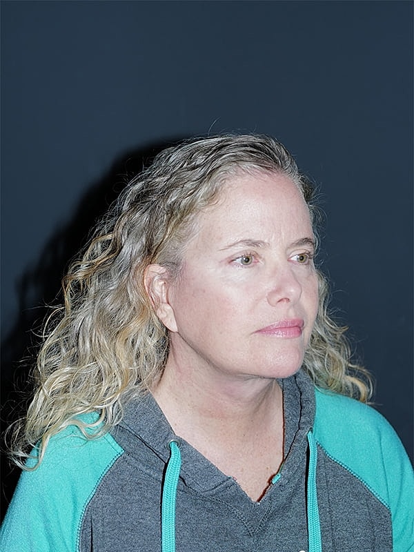 Blepharoplasty Before & After