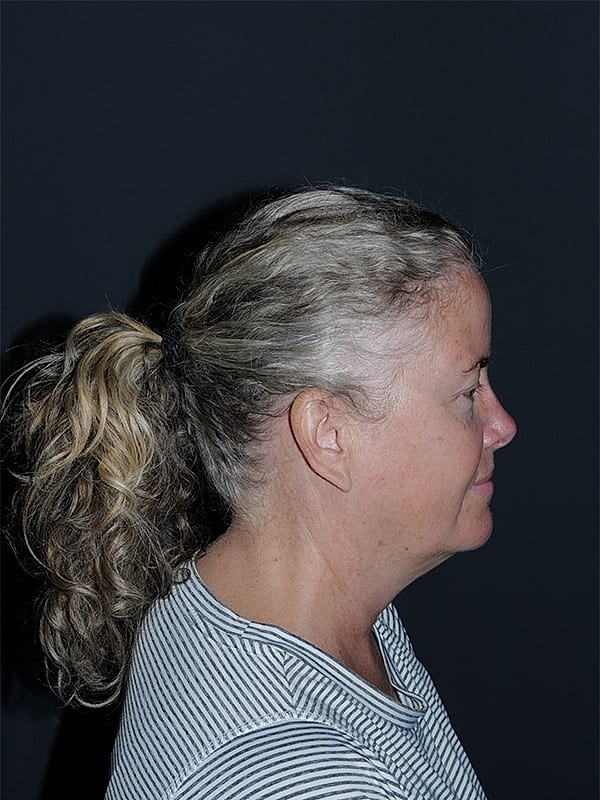 Blepharoplasty Before & After