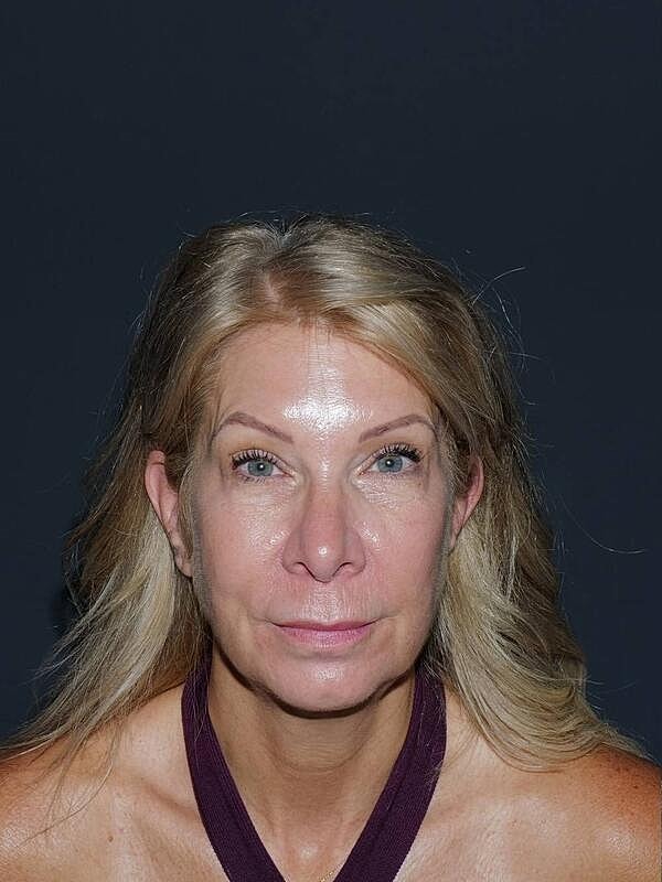 Blepharoplasty Before & After