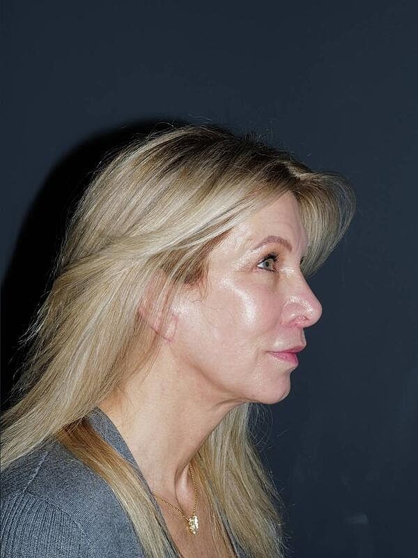 Blepharoplasty Before & After