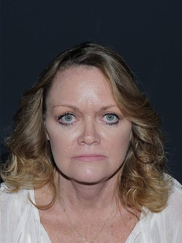 Blepharoplasty Before & After