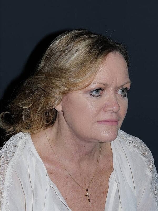 Blepharoplasty Before & After