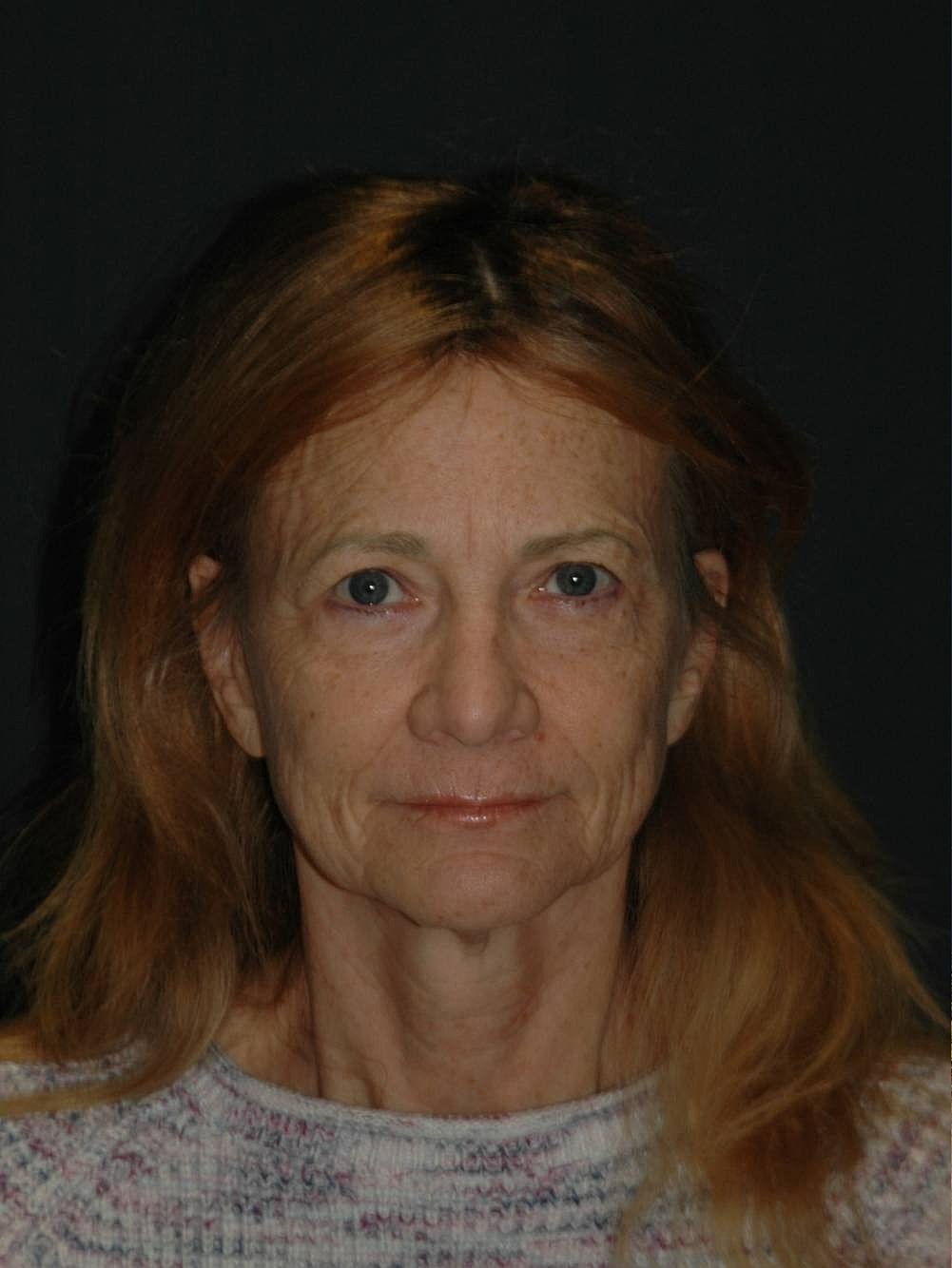 Blepharoplasty Before & After