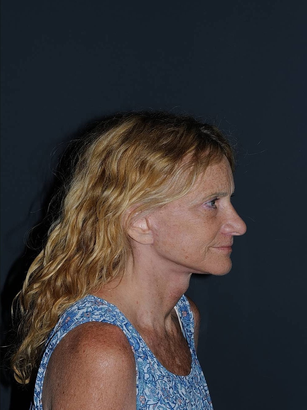 Blepharoplasty Before & After