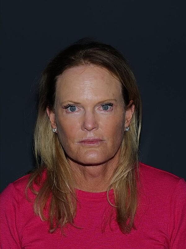 Blepharoplasty Before & After