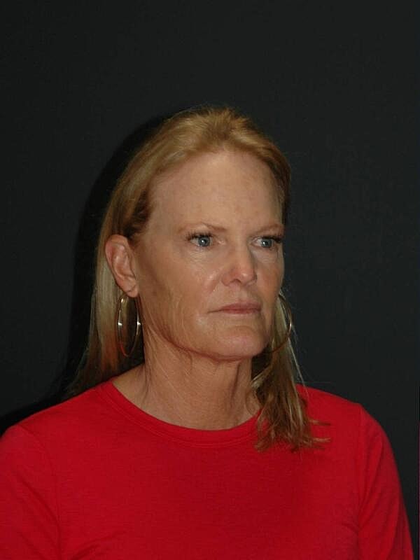 Blepharoplasty Before & After